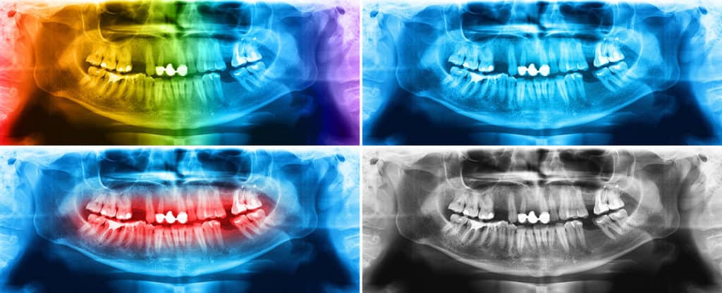 SDAGD – Open Bite and Jaw Dislocation with Oral Appliance Therapy: Zoom ...